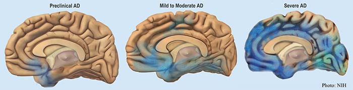 Cognitive Decline